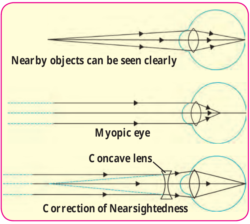 Figure 7.13 – Nearsightedness and its correction