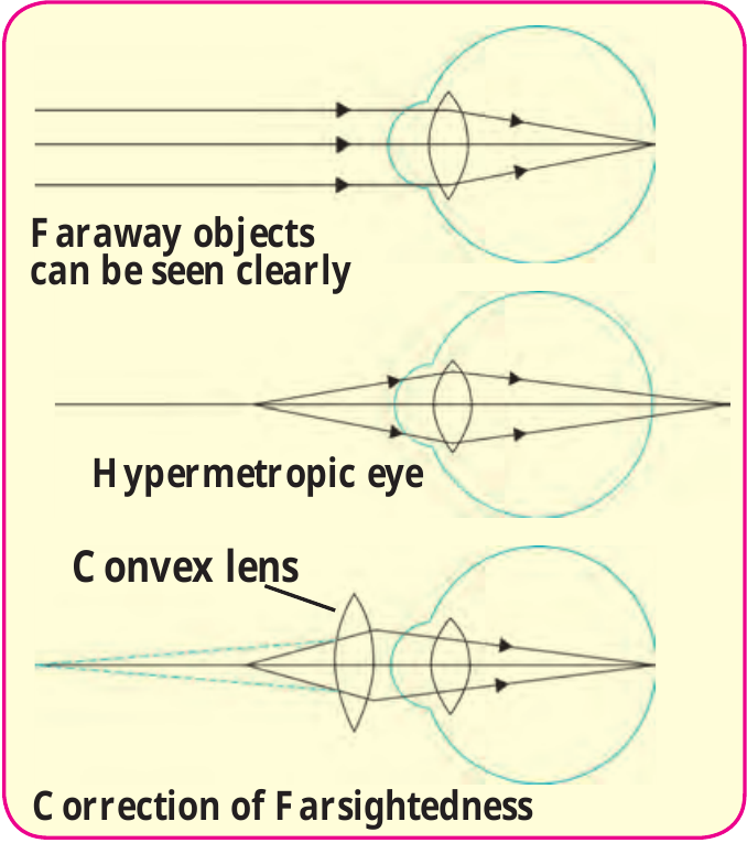 Figure 7.14 – Farsightedness and its correction